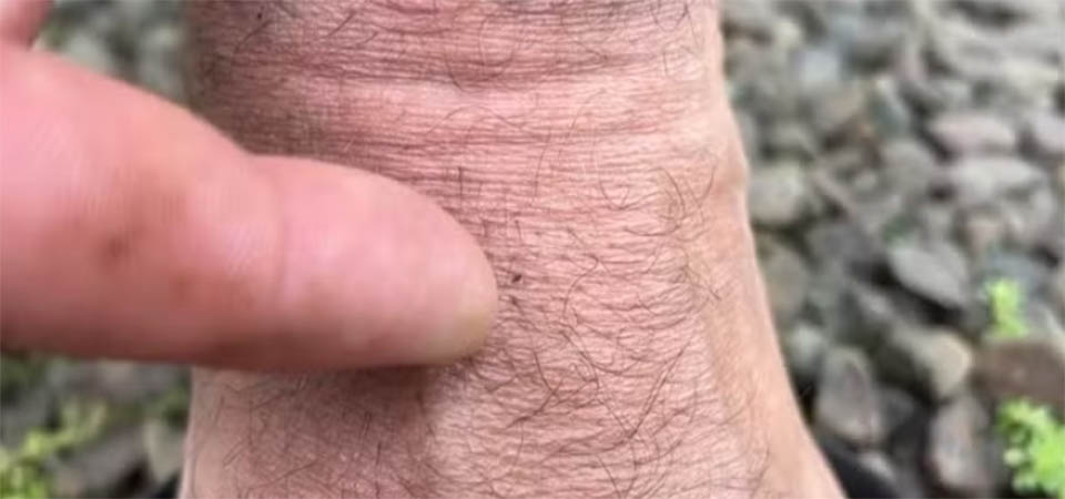 Mato Grosso registra 11 casos confirmados de febre Oropouche