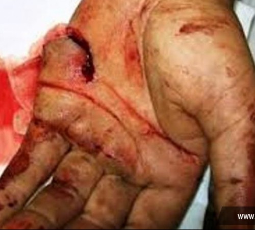 Sorriso: Garis sofrem acidentes com materiais cortantes e perfurantes jogados de forma irresponsável no lixo doméstico