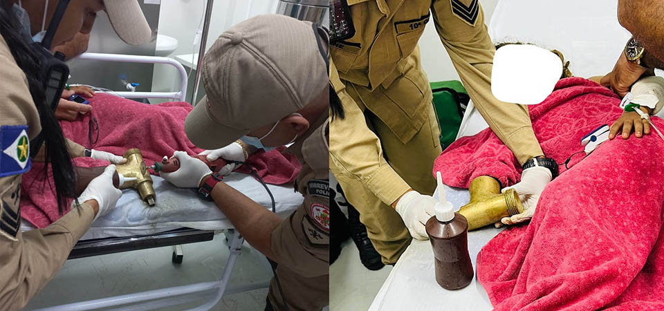 Menina de 4 anos teve dedos amputados após prender a mão em cilindro