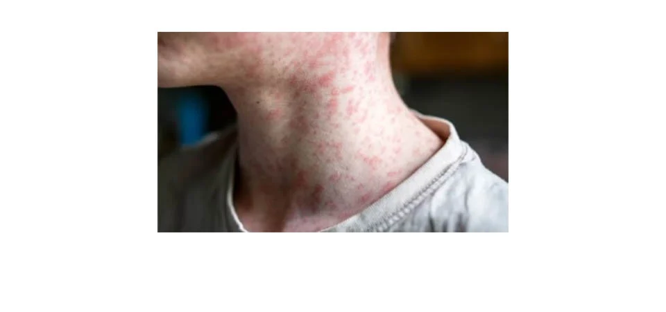 Casos de sarampo confirmados acendem alerta em Mato Grosso