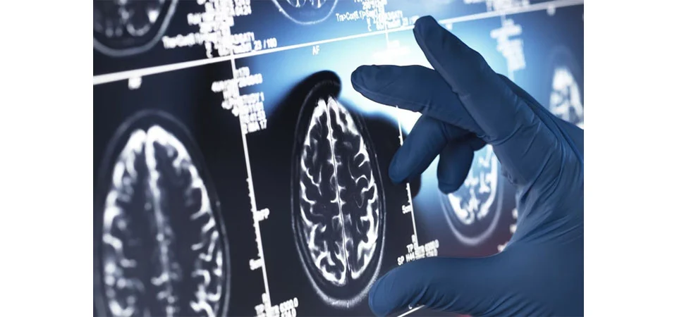 Paciente mais jovem com Alzheimer teve sinais aos 17 anos. Saiba quais