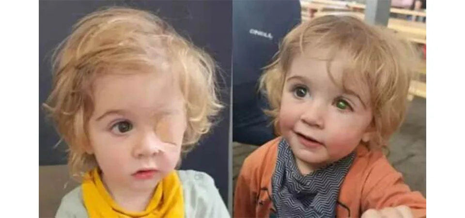 Menino perde a visão após ser beijado por pessoa com herpes