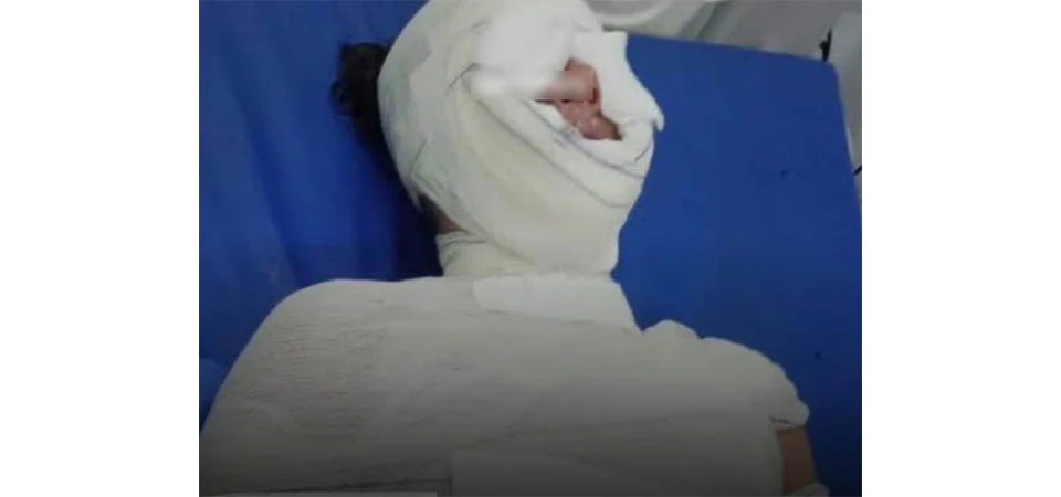 Mulher fica ferida após colocar panela de pressão quente embaixo da torneira e panela explodir