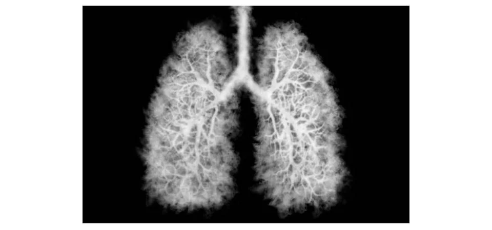 ‘Pulmão de pipoca’: entenda a doença sem cura e sua relação com cigarros eletrônicos