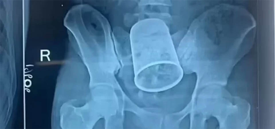 Homem enfia copo de vidro no a**s e é internado no Hospital