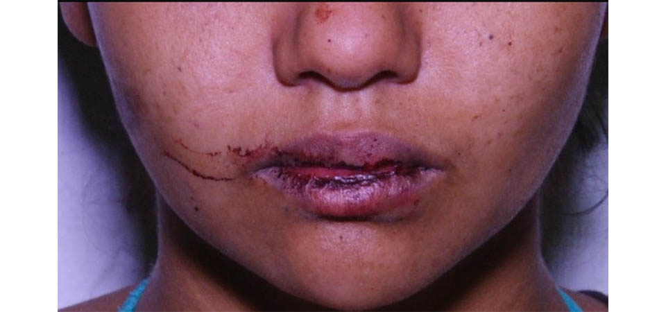 Membros do CV cortam pedaço da língua de jovem de 15 anos