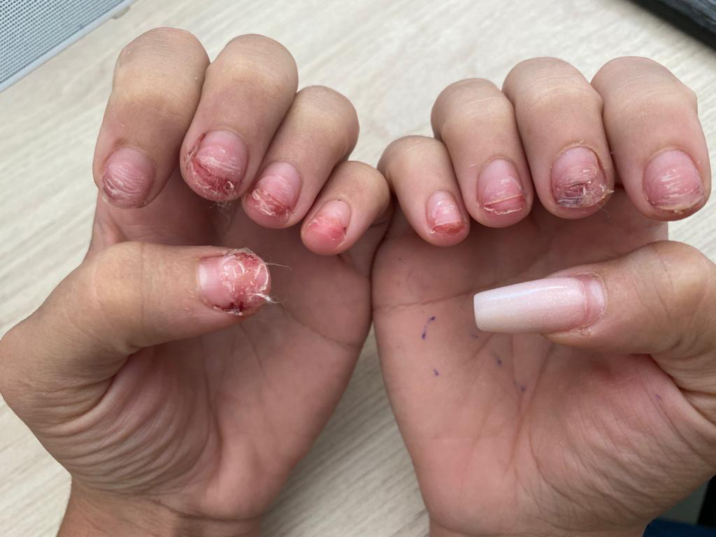 Ipiranga: Mulher perde unhas das mãos após ser espancada pelo ex marido