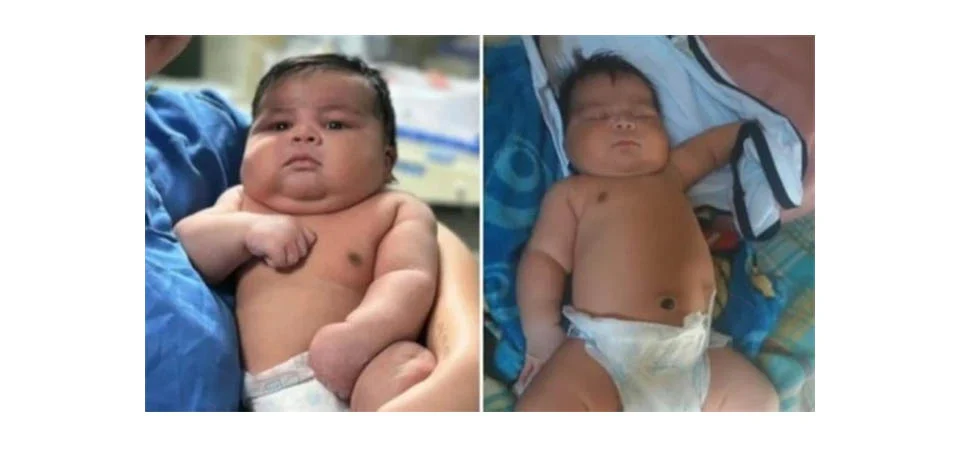 Bebê de 6,5 kg nasce de parto normal e mãe precisa de 55 pontos