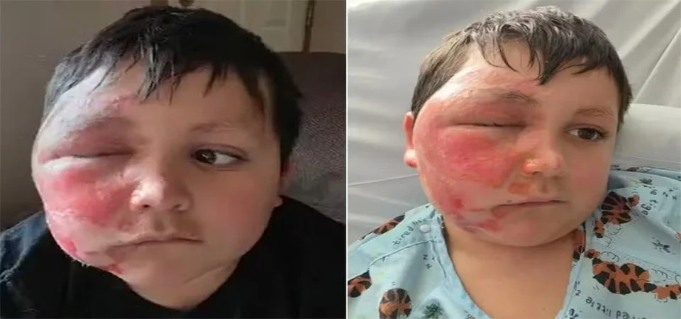 Menino fica com o rosto deformado após participar de desafio no TikTok