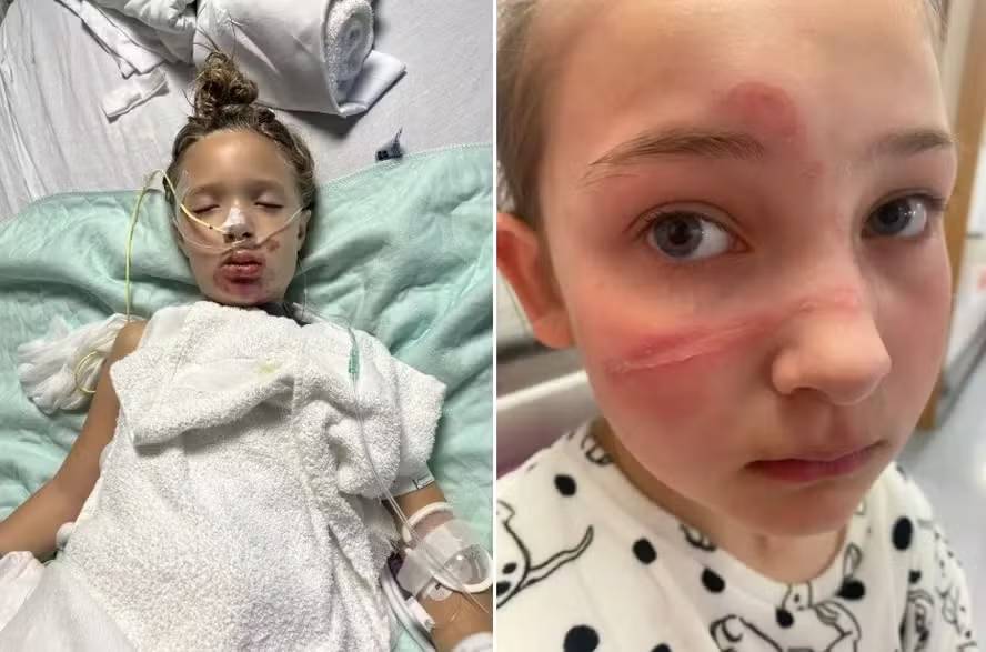 Número de acidentes com explosão de brinquedo em trend viral se multiplica