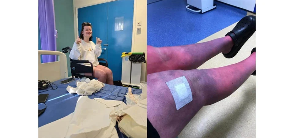 Após dar à luz, mãe é diagnosticada com doença que “incendeia” a pele