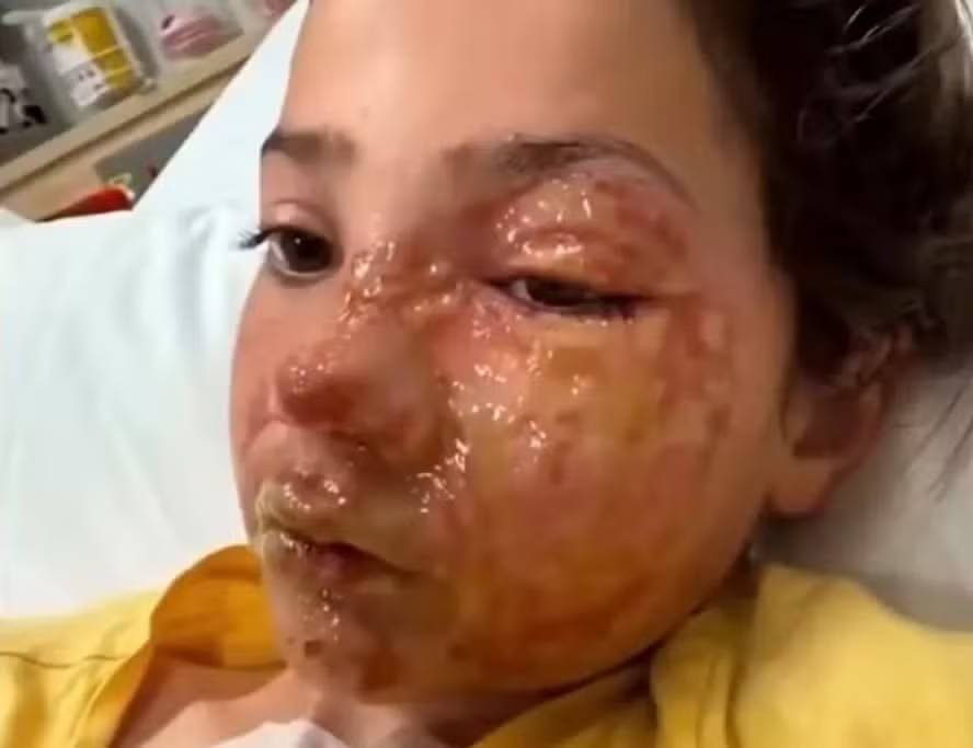 Menina de 10 anos fica com queimaduras no rosto após participar de desafio viral