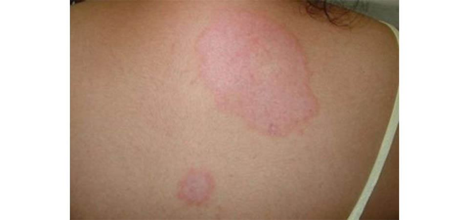 Itanhangá: Secretaria De Saúde alerta para os cuidados e sintomas da hanseníase