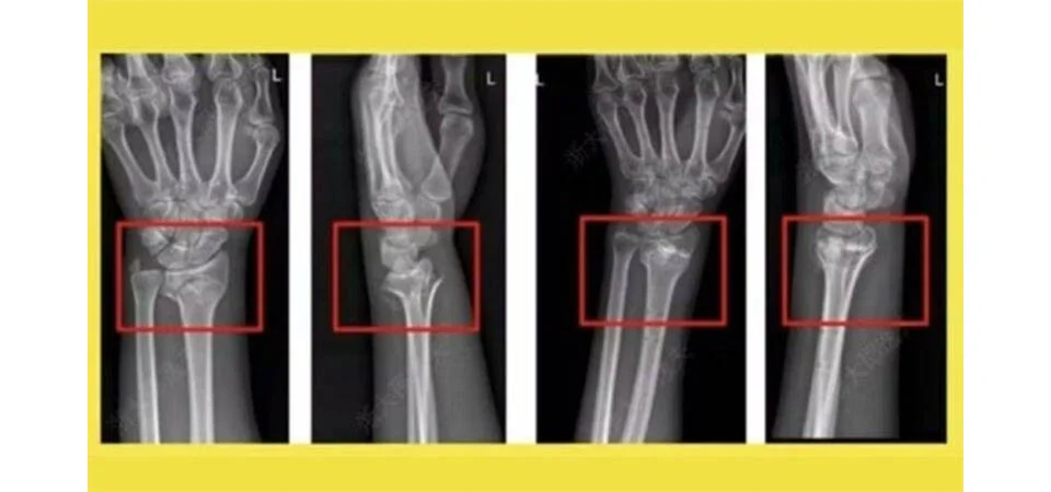 Cientistas chineses criam supercola óssea capaz de resolver fraturas em minutos